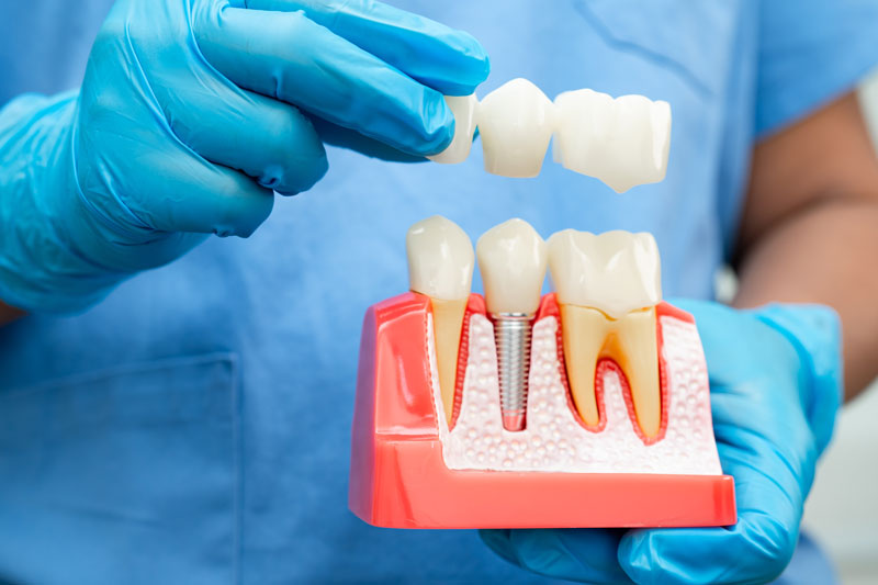 Dentist holding a dental implants model with blue gloves on in a dental office.